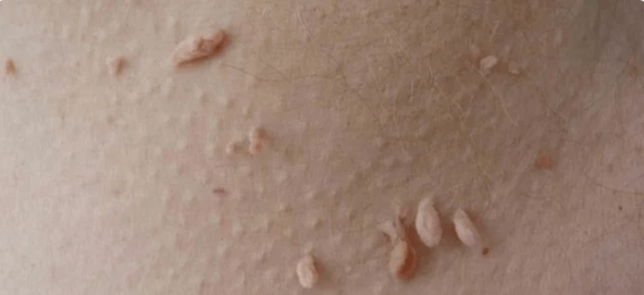 HPV delivery method