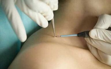 The method of removal of papillomas