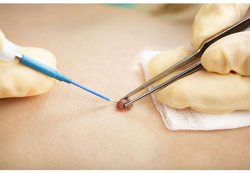 Remove papillomas