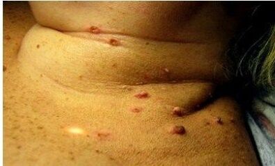 Photos of many papilloma on women
