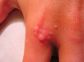 How to get rid of a small papilloma