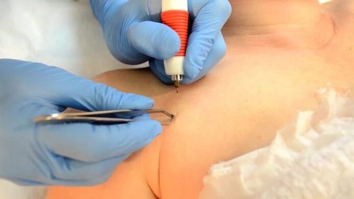 Electrocoagulation - a method for removing papilloma