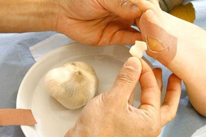 Papilloma treatment with garlic compression