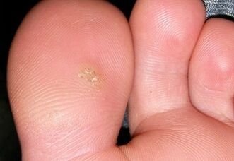 How to Get Rid of Plantar Warts