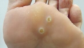 What do plantar warts look like