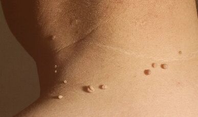 Causes of papillomas