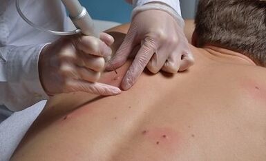 How to Remove Papilloma