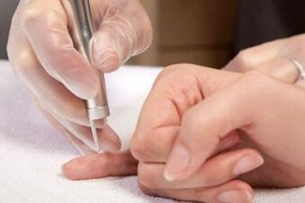 how to get rid of papilloma on the body