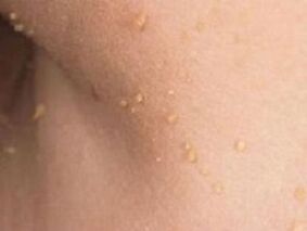 the reason for the appearance of papillomas on the body