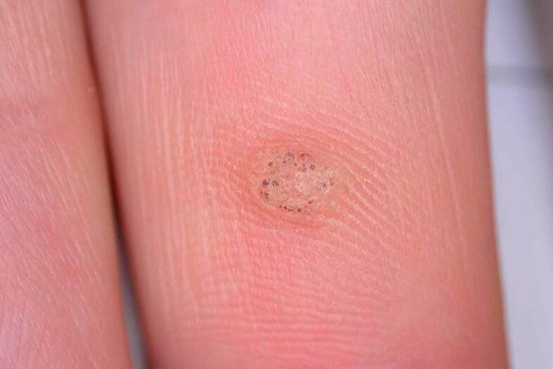 what is a wart