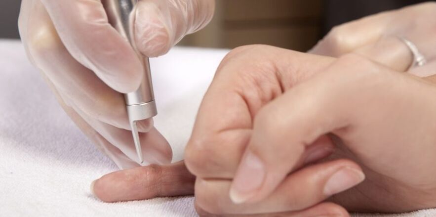 how to remove papilloma on the hands and why it is dangerous