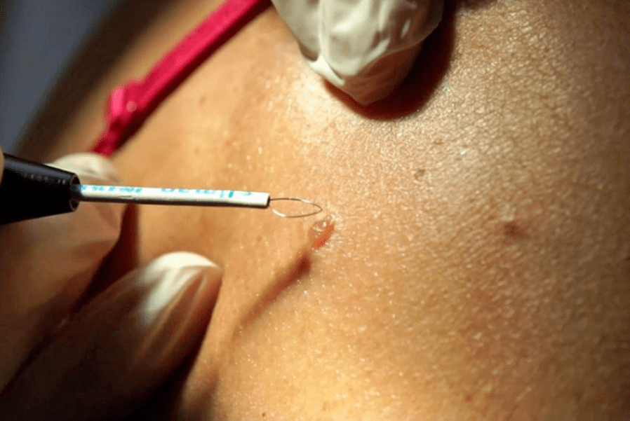 professional method to remove papilloma
