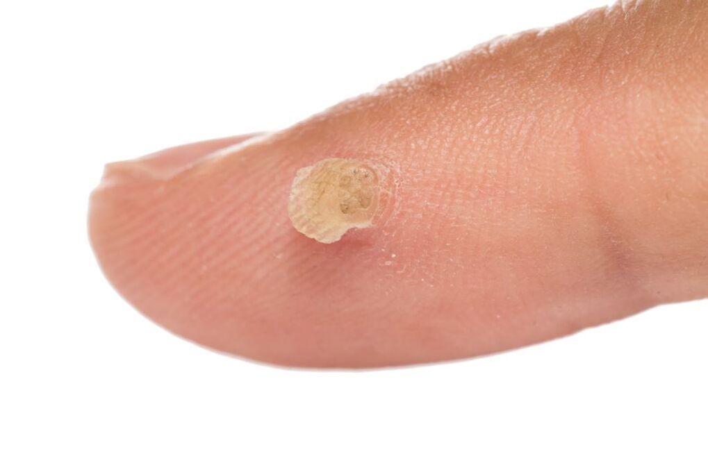 genital warts on fingers