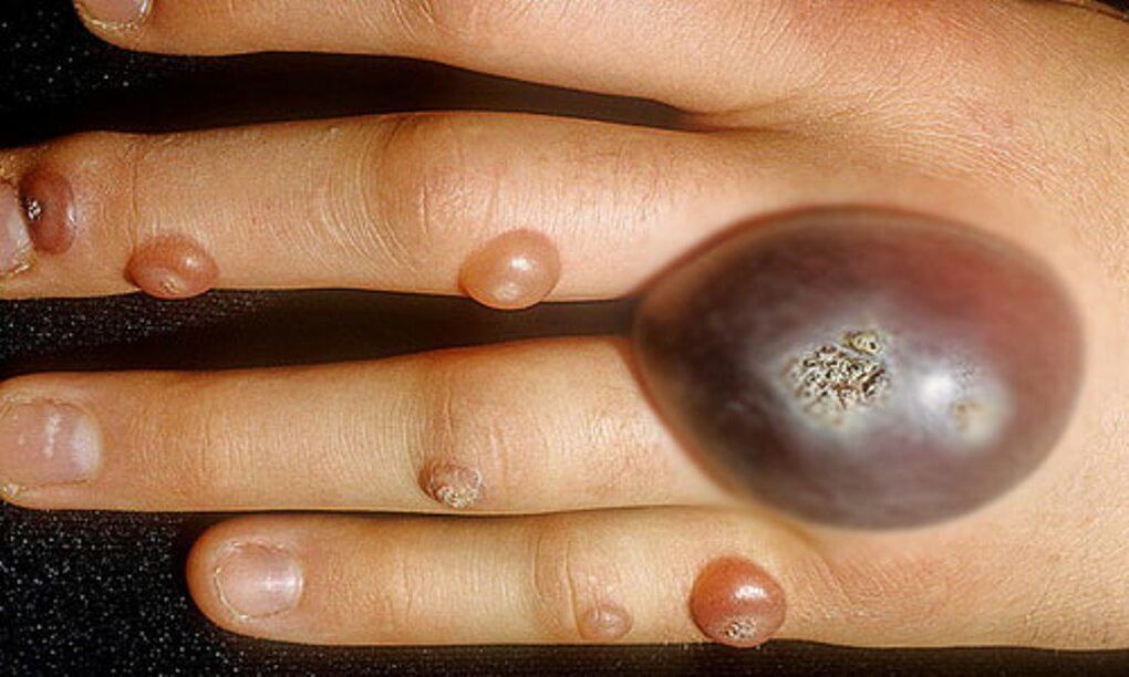 large wart on hand