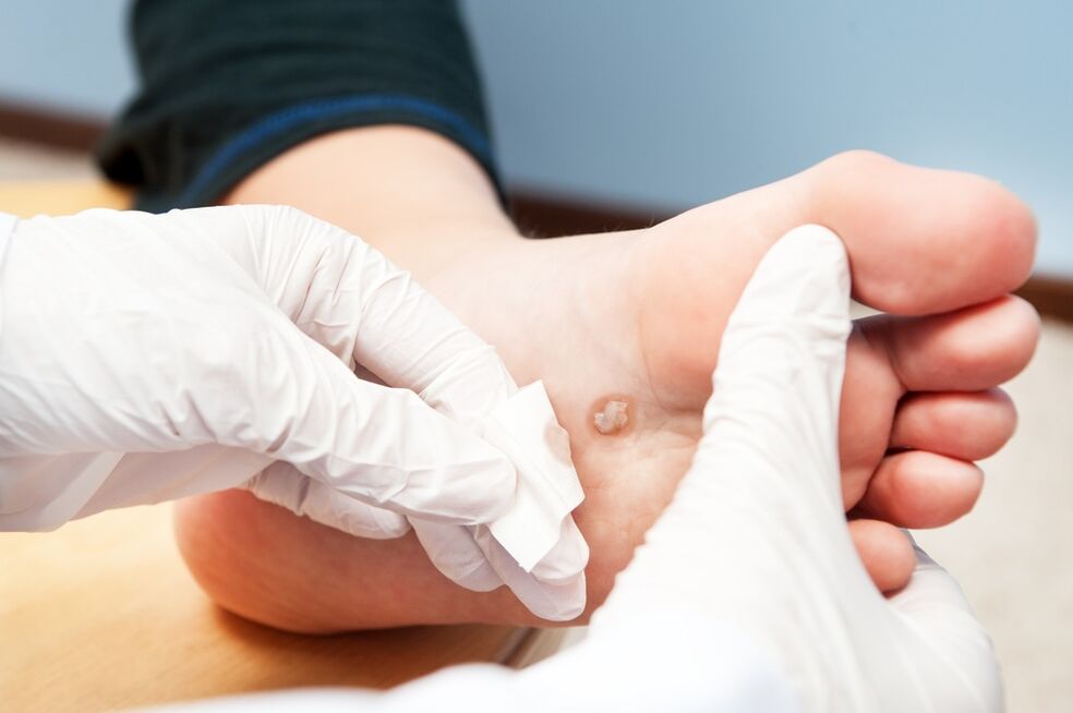 wart treatment