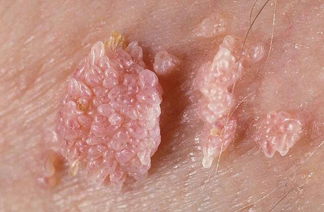 Papilloma is a benign tumor-like formation on the skin and mucous membrane that is warty