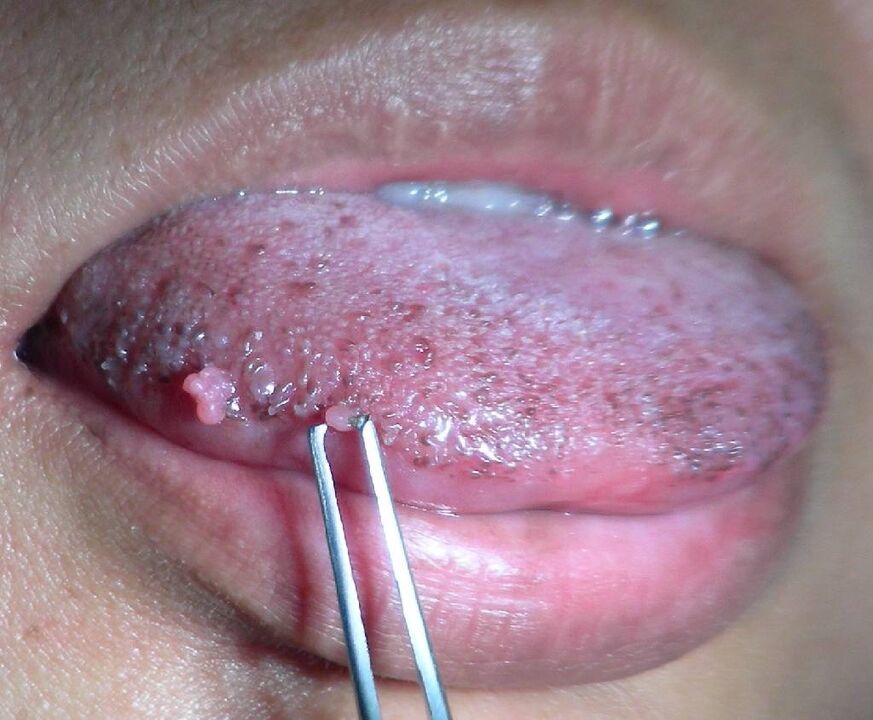 Papilloma on the tongue