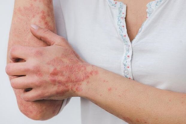 treatment of skin diseases with Keramin